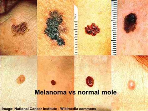 liver spots vs melanoma